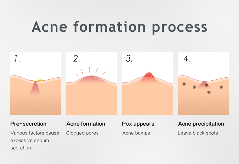Celecare odm pimple band aid company for removing acne-2