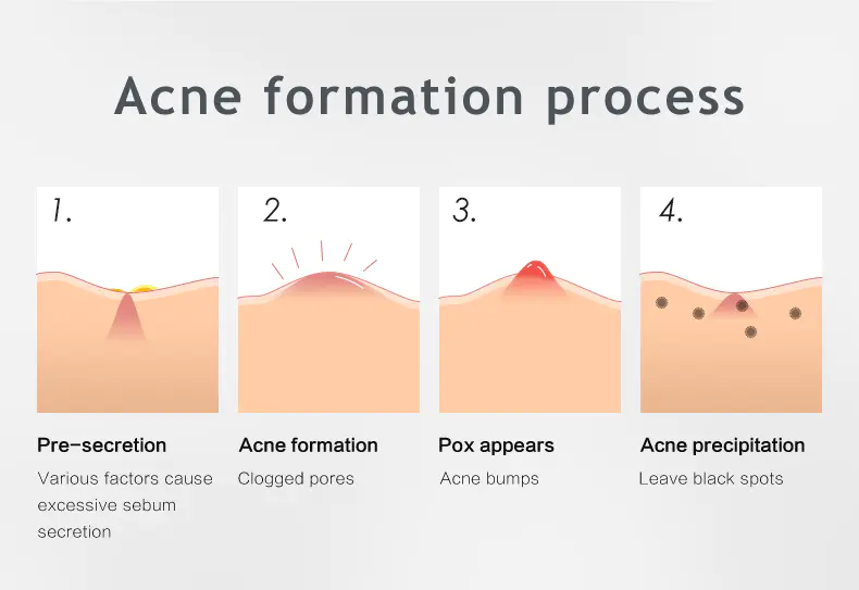 practical micro needle acne patch manufacturer for removing acne
